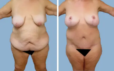 Before and After